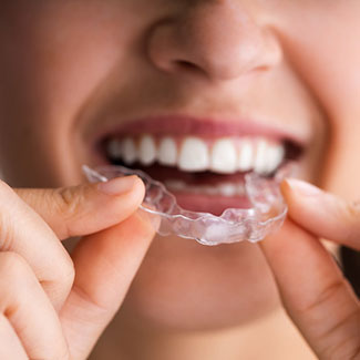 clear aligners